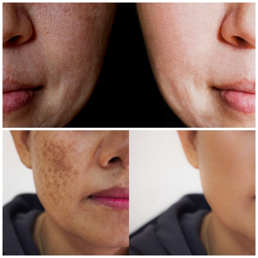 Creme Clareador Rosa Mosqueta + Ácido Kójico: antes e depois