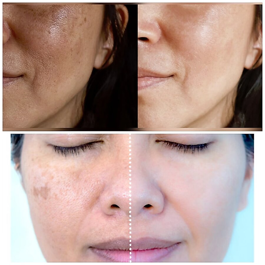 Creme Clareador Rosa Mosqueta + Ácido Kójico: antes e depois